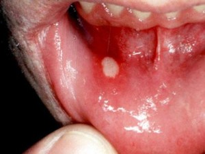 canker sore